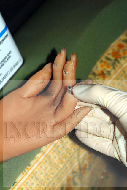 Finger repair (6b)